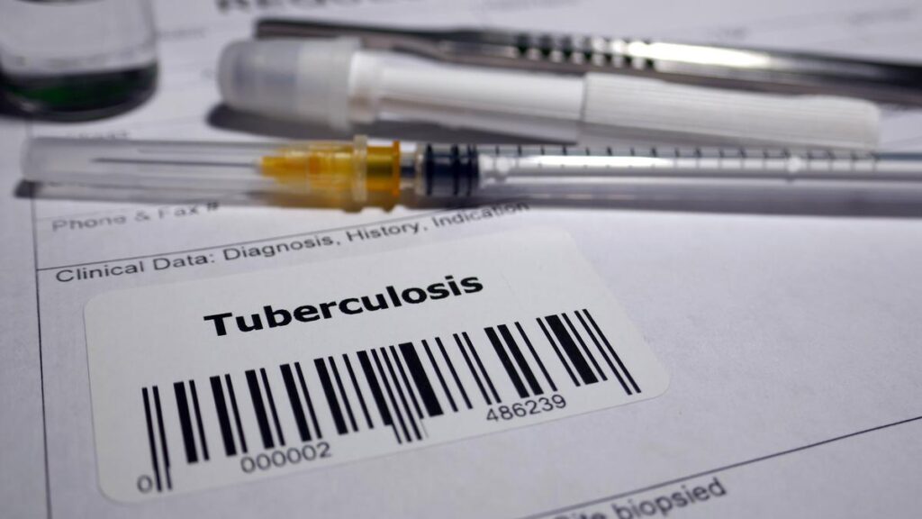 Global TB funding lags, reaching only a quarter of WHO targets